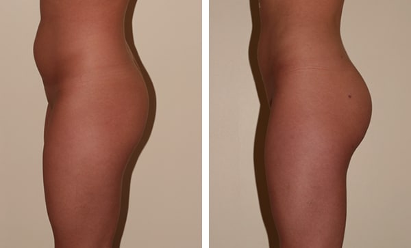 lipofilling-fesse-Tunisie