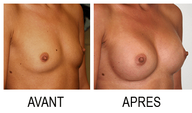 lipofilling mammaire Paris avant apres