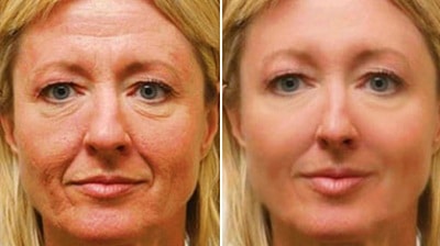lifting visage Paris