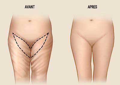 lifting cuisses Paris prix