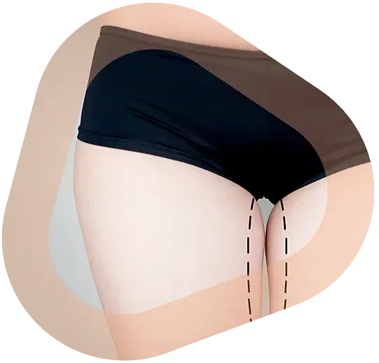 Lipofilling fessier Paris